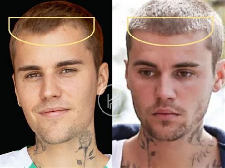 All About Justin Bieber's Hair Transplant Journey