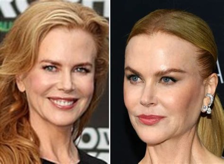 Did Nicole Kidman Undergo A Facelift? Exploring Her Transformation