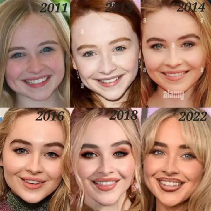 Does Sabrina Carpenter's Transformation Include Lip Fillers?