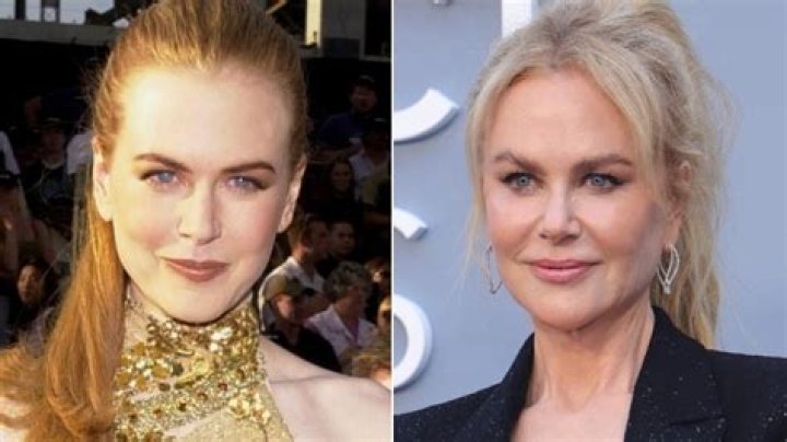 Nicole Kidman's Dramatic Transformation: Before And After Facelift
