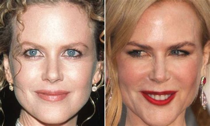The Truth About Nicole Kidman's Fillers: A Comprehensive Guide