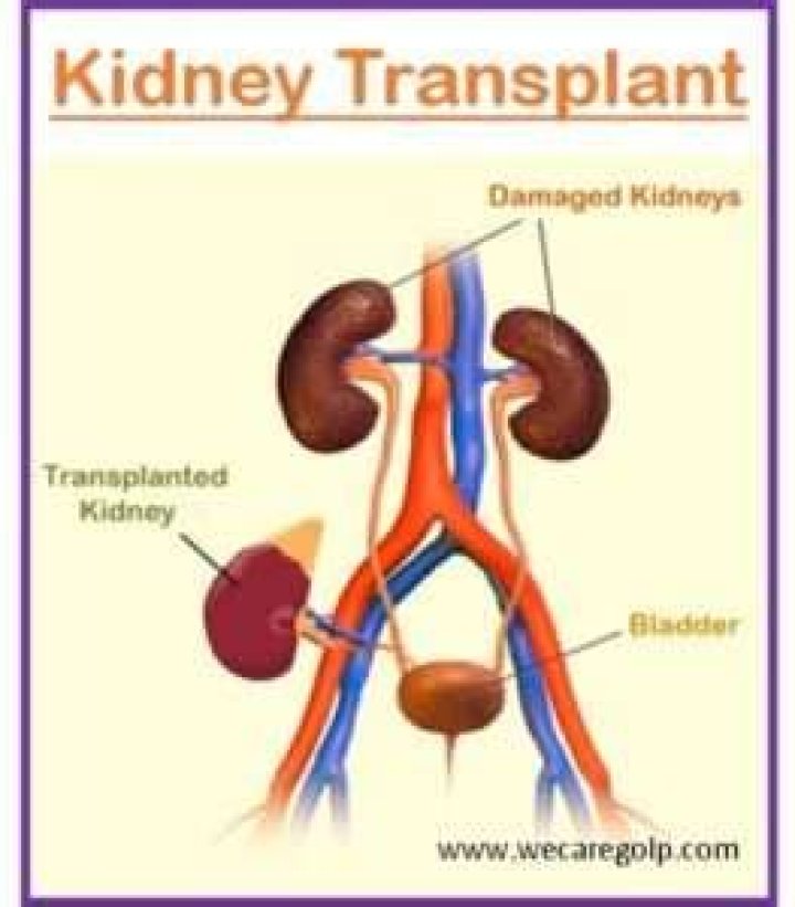 Understanding The Journey Of Kidney Transplant Scars