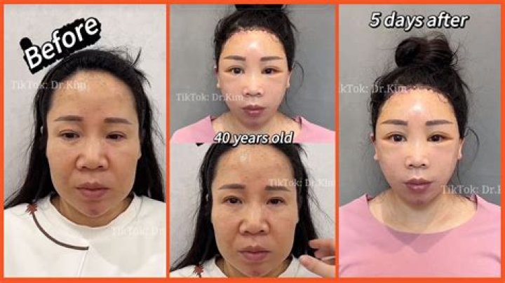 Unveiling The Truth: Shin Hye-sun's Plastic Surgery Journey